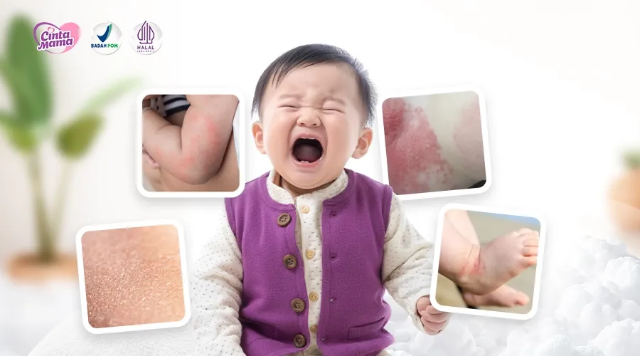 Mengenal 8 Jenis Gatal pada Kulit Bayi i Beserta Gambar dan Cara Mengatasinya