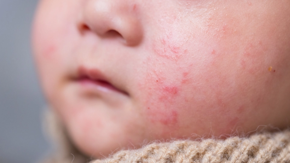 biang keringat pada pipi bayi