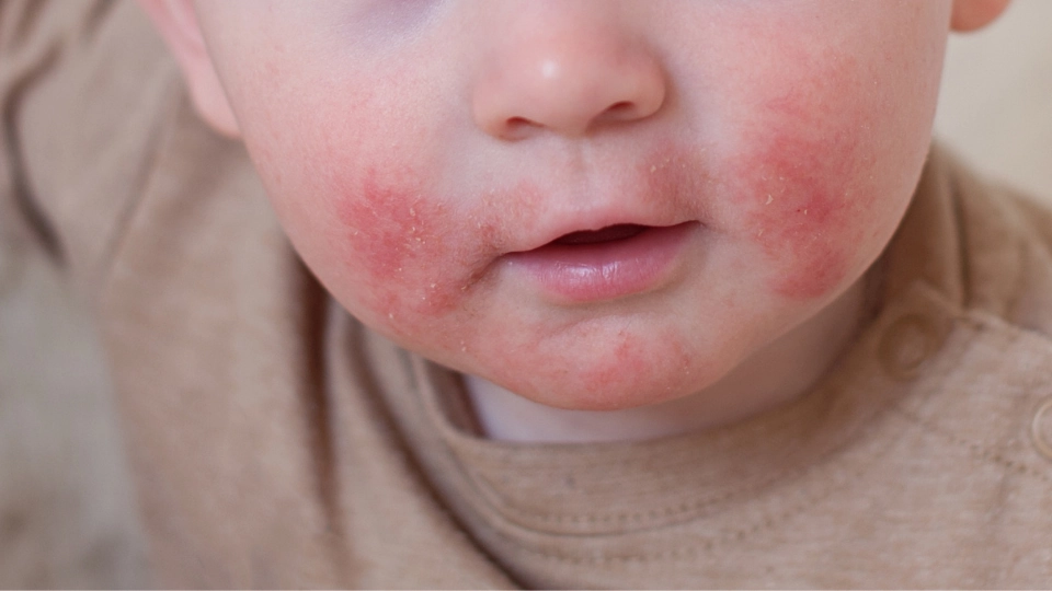 eksim pada kulit bayi