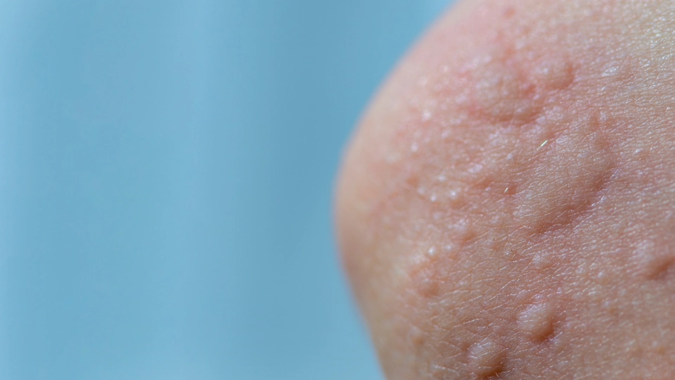 biduran pada kulit bentol-bentol kemerahan seperti pulau-pulau